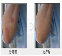 夏季牛皮癣的护理有哪些