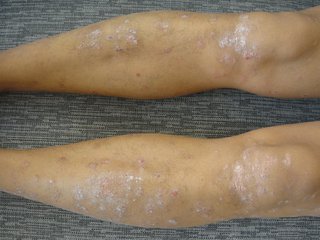 牛皮癣患者用药时有哪些注意事项