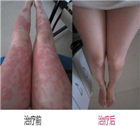 顽固的牛皮癣我们应该怎么办呢