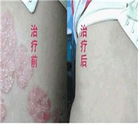 牛皮癣要怎么治疗的效果最好呢